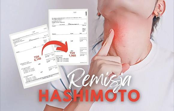 Jak wyleczyć tarczycę bez leków i osiągnąć remisję hashimoto